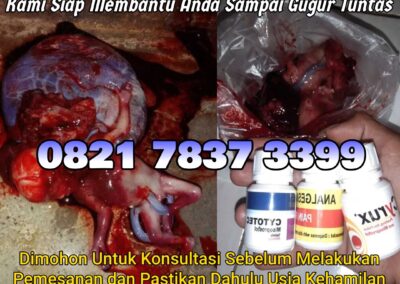 Jual Obat Aborsi Cytotec, 082178373399  Misoprostol Asli, dan Gastrul di Apotek Menggugurkan Kandungan Di Madailing Natal Cod